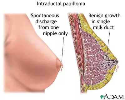 Intraductal Papilloma